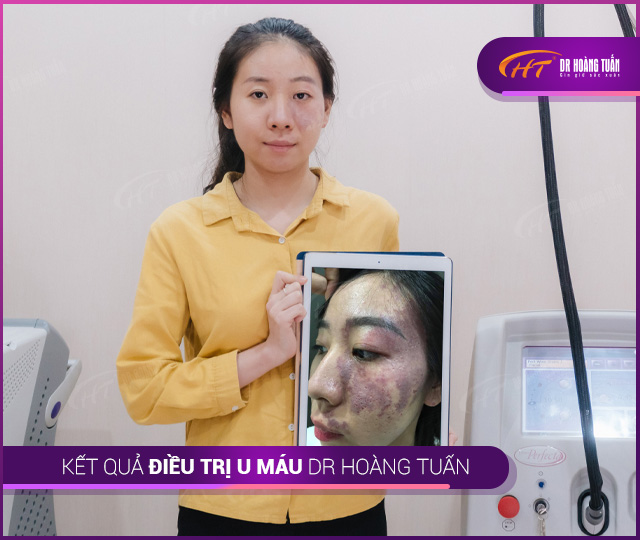 Kết quả trị u máu - bớt máu